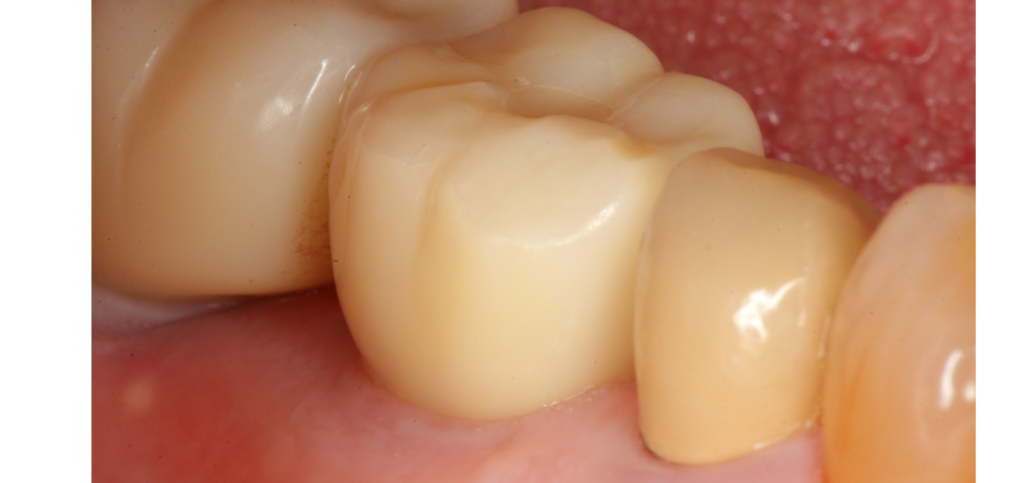 Final restoration with a natural emergence profile shaped by custom healing abutments.