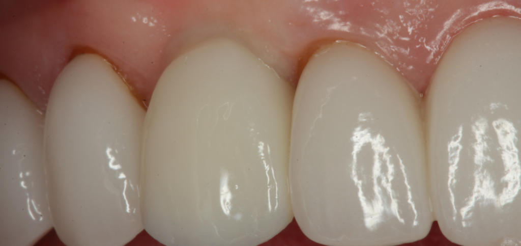 Close-up of a final esthetic zone restoration with tissue contours shaped by custom healing abutments.