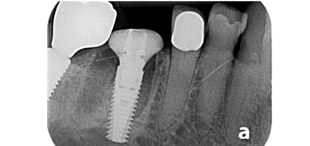 Periapical radiograph confirming implant and socket sealing abutment placement in a case using custom healing abutments.