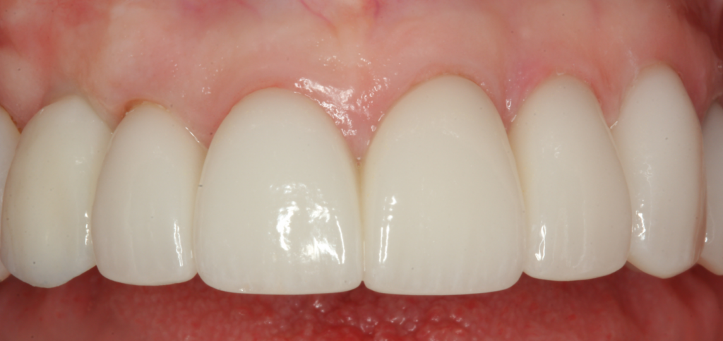 Final esthetic zone restoration with a natural emergence profile shaped by custom healing abutments.