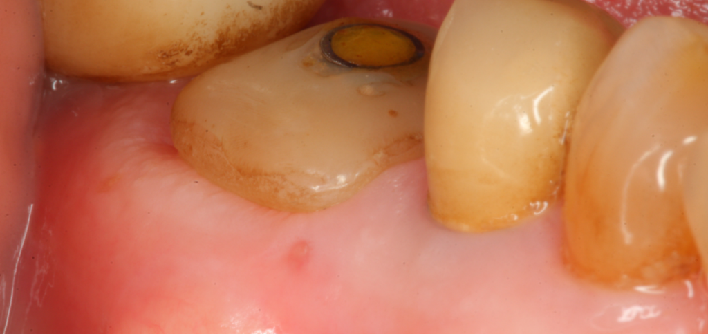 Peri-implant tissue developing a natural emergence profile two weeks after placement of custom healing abutments.