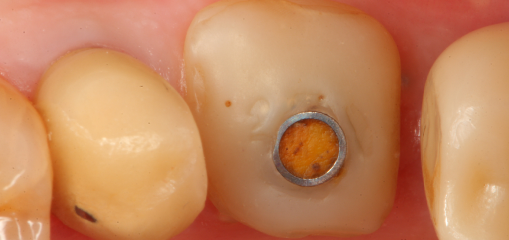 At a two-month follow-up, showing stable contours shaped by custom healing abutments.