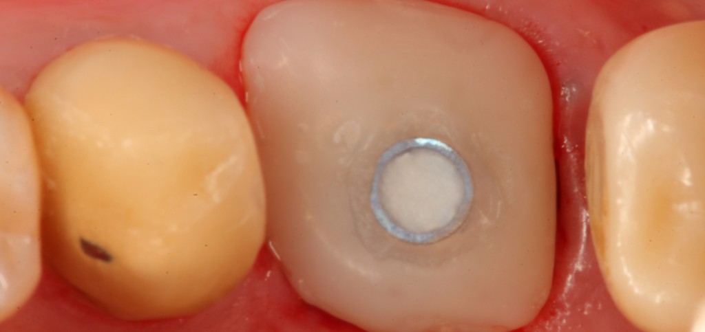 Socket sealing abutment seated in the extraction socket, part of a case using custom healing abutments.