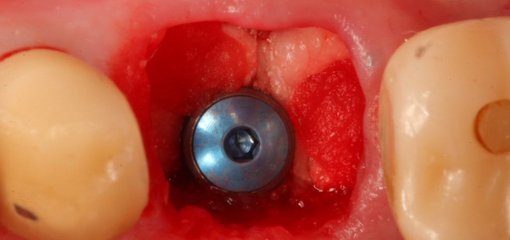 Scan body capturing molar extraction socket anatomy to guide fabrication of custom healing abutments.