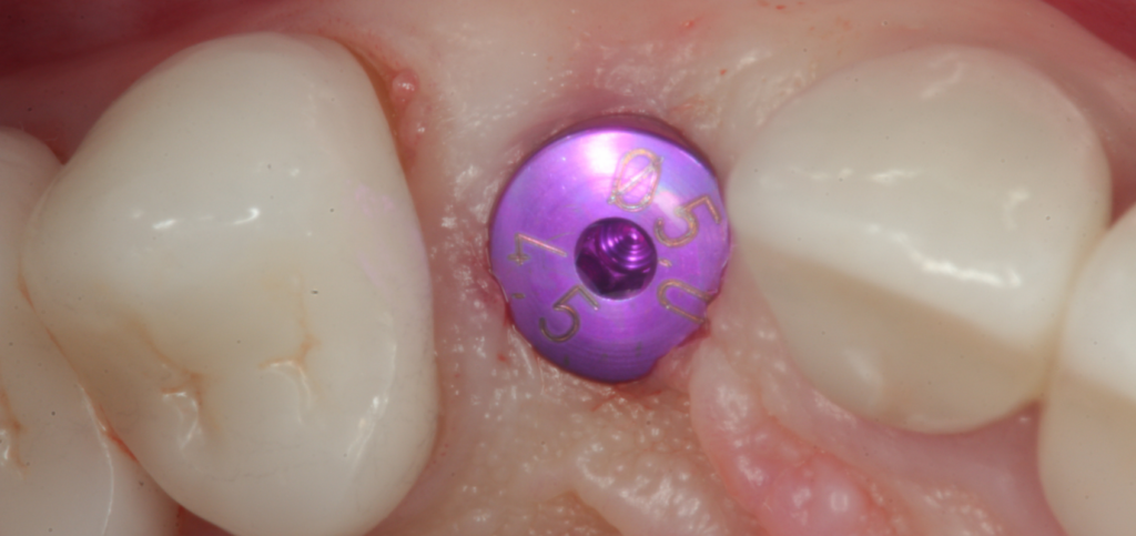 Stock round healing abutment in a healed esthetic zone site, the baseline before custom healing abutments is introduced.