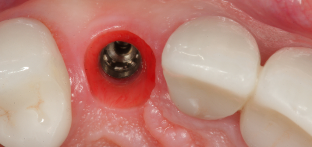 Implant cover screw exposed in the esthetic zone prior to custom healing abutments shaping the tissue.