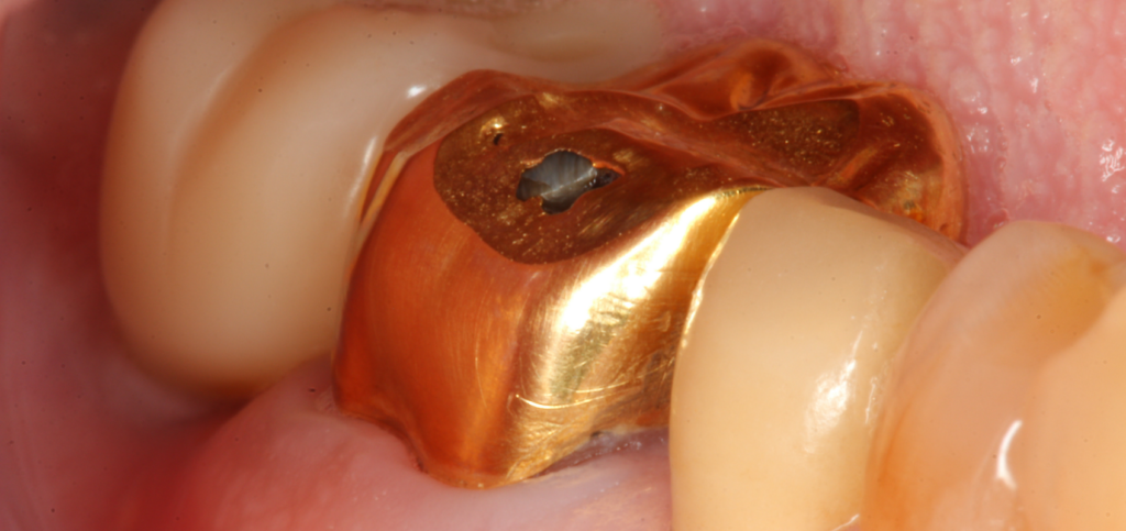Custom gold coping replacing custom healing abutments to refine the final emergence profile.