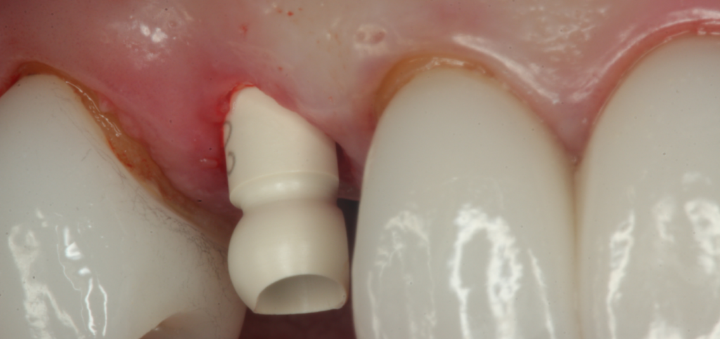 Scan body capturing implant position to design custom healing abutments in the esthetic zone.