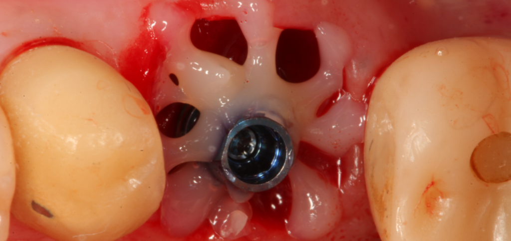Buccal view of the extraction socket used to capture anatomy for custom healing abutments.