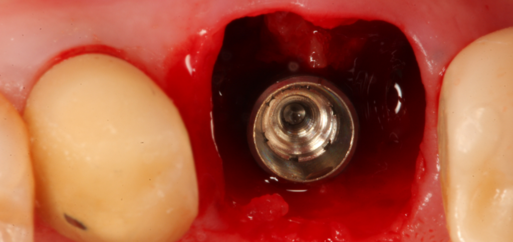 Immediate implant placed in a molar extraction socket before custom healing abutments are fabricated.