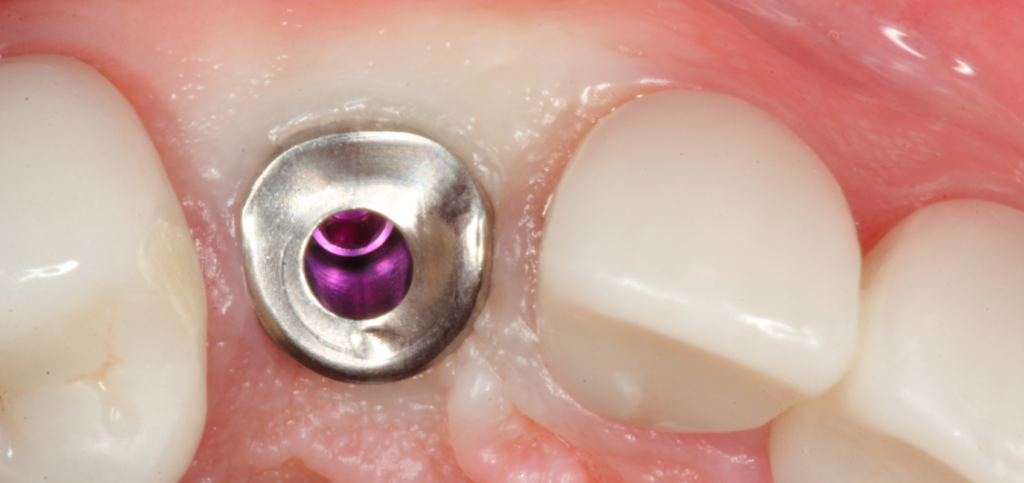 Custom healing abutment seated in the esthetic zone.