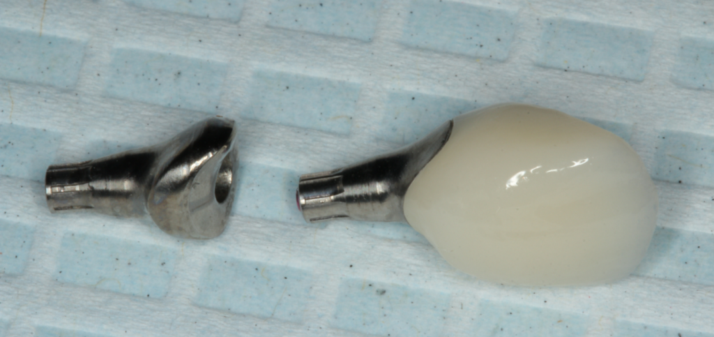 Milled titanium base and finished ceramic crown, digitally fabricated to replicate the contours established by custom healing abutments.