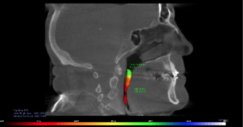 The Dentist’s Role in Airway Health: 10 Years of Change A sagittal CBCT scan with color-coded airway volume mapping, illustrating the three-dimensional view now central to the dentist’s role in airway health.