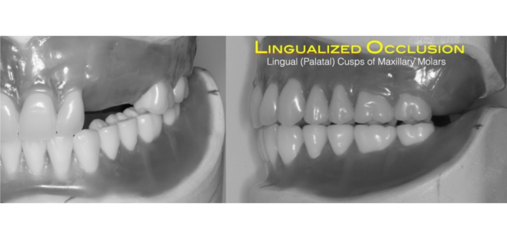 Occlusion Fundamentals: The Official Guide for Dentists Modified denture setup demonstrating lingualized occlusion for an edentulous patient