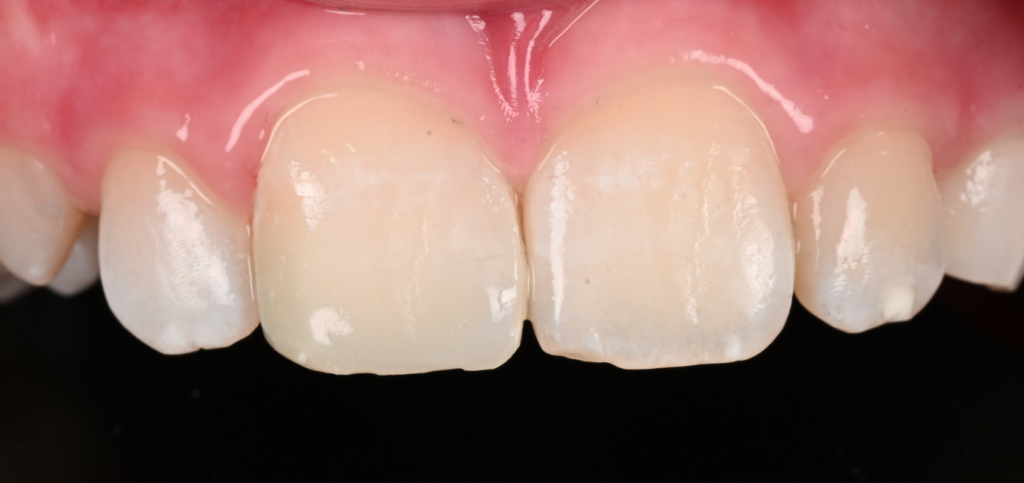 Restored maxillary central incisor after vital pulp therapy, showing a successful outcome from managing endodontic emergencies.