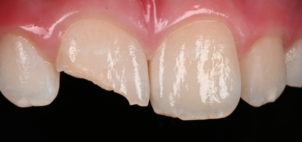 Complicated crown fracture on a maxillary central incisor with pulp exposure, a case dentists see when managing endodontic emergencies.