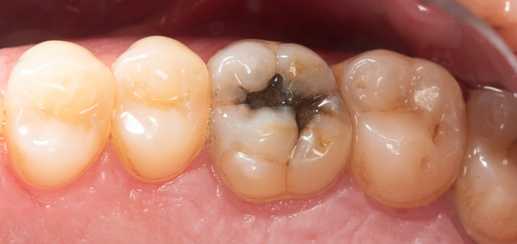 Incomplete crown fracture with a visible cracked tooth fissure on a molar, an example relevant to managing endodontic emergencies.
