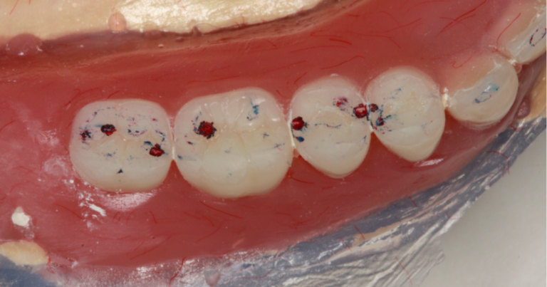 Spear Digest Posterior teeth on a dental model showing occlusion contact points marked with red and blue articulating paper