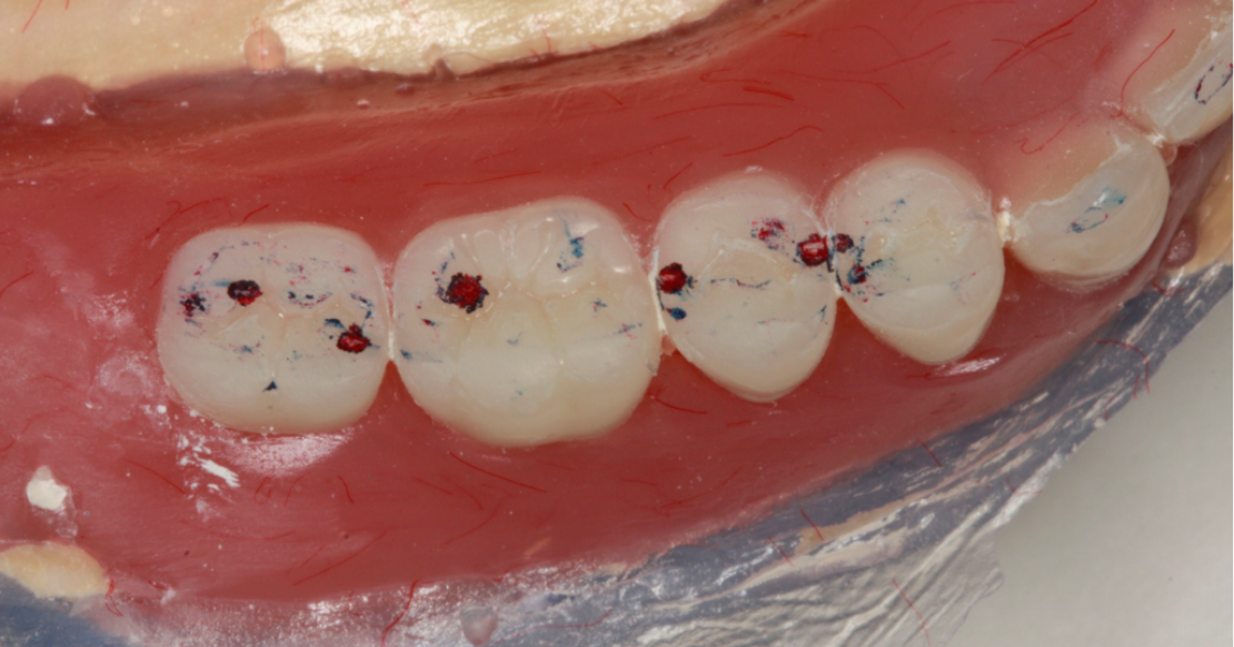 Occlusion Fundamentals: The Official Guide for Dentists Posterior teeth on a dental model showing occlusion contact points marked with red and blue articulating paper