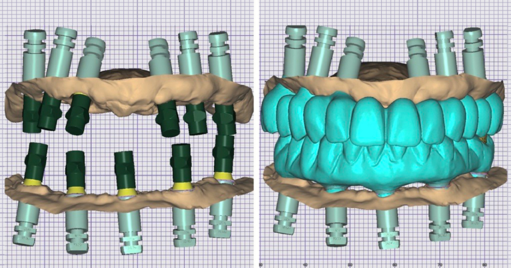 Photogrammetry for Dental Implants: The Cost of Efficiency CAD design stages showing full-arch implant prostheses created using photogrammetry for dental implants