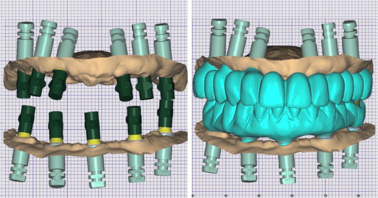 Spear Digest CAD design stages showing full-arch implant prostheses created using photogrammetry for dental implants