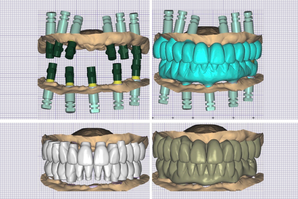 Photogrammetry for Dental Implants: The Cost of Efficiency CAD design stages showing full-arch implant prostheses created using photogrammetry for dental implants