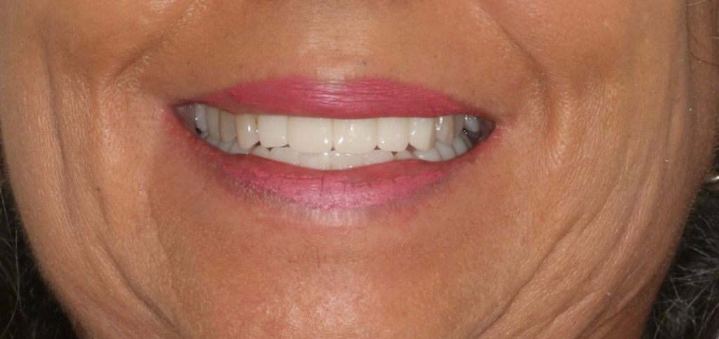 Photogrammetry for Dental Implants: The Cost of Efficiency Final smile after full arch treatment using photogrammetry for dental implants for a milled provisional bridge