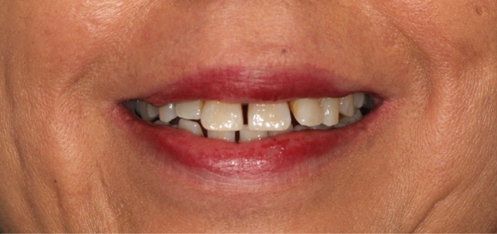 Photogrammetry for Dental Implants: The Cost of Efficiency Preoperative smile before using photogrammetry for dental implants for a maxillary implant bridge