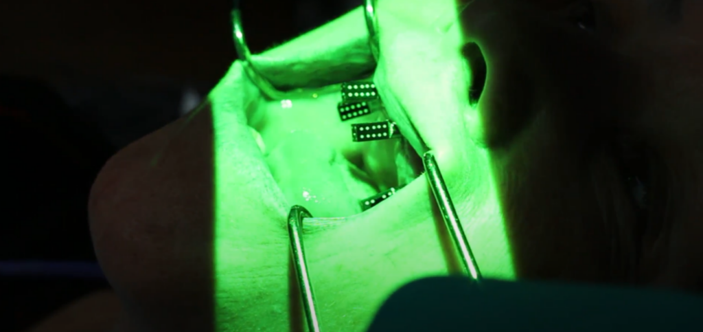 Photogrammetry for Dental Implants: The Cost of Efficiency Intraoral markers captured during photogrammetry for dental implants using a green-light scanning device