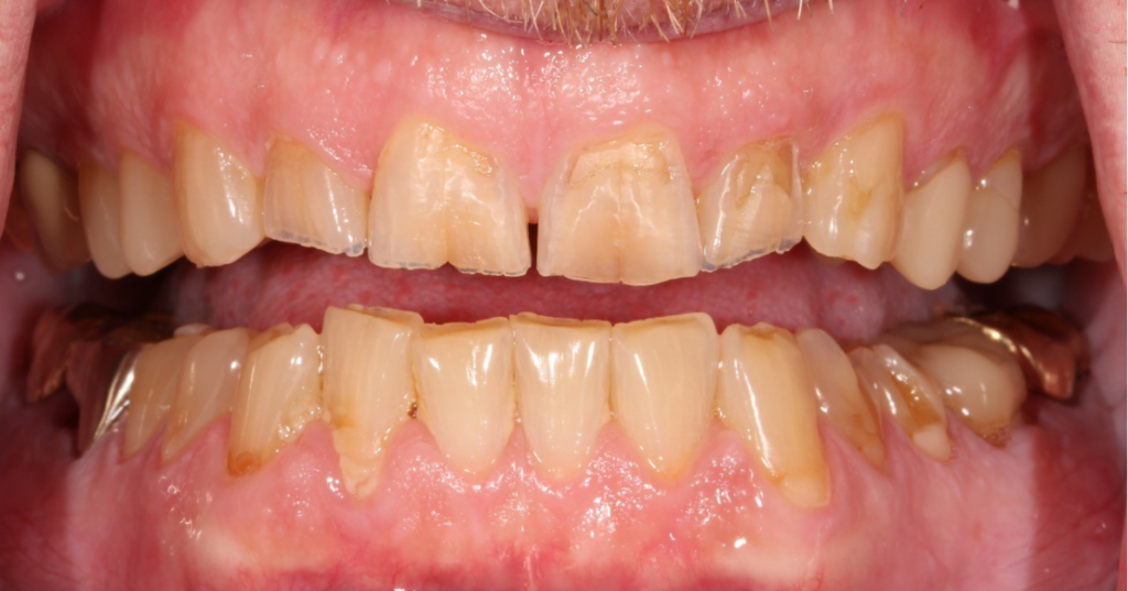 Restoring a Worn Dentition: Essential Treatment Considerations Close-up of anterior segmental wear before restoring a worn dentition, with uneven incisal edges on the upper central incisors