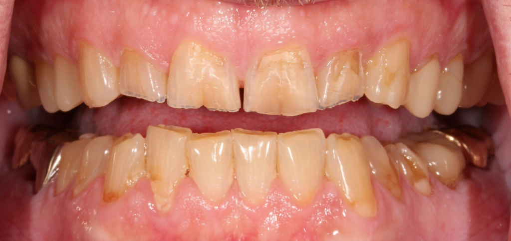 Restoring a Worn Dentition: Essential Treatment Considerations Close-up of anterior segmental wear before restoring a worn dentition, with uneven incisal edges on the upper central incisors