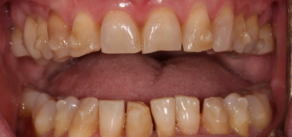 Restoring a Worn Dentition: Essential Treatment Considerations Orthodontic treatment to create restorative space before trial therapy