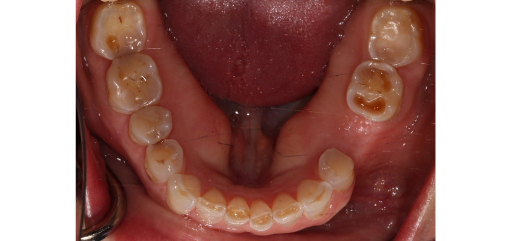 Restoring a Worn Dentition: Essential Treatment Considerations Full mouth view of generalized wear across both arches before restoring a worn dentition treatment.
