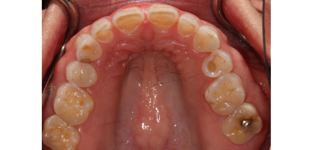 Restoring a Worn Dentition: Essential Treatment Considerations view of generalized wear across the upper arch before restoring a worn dentition treatment.
