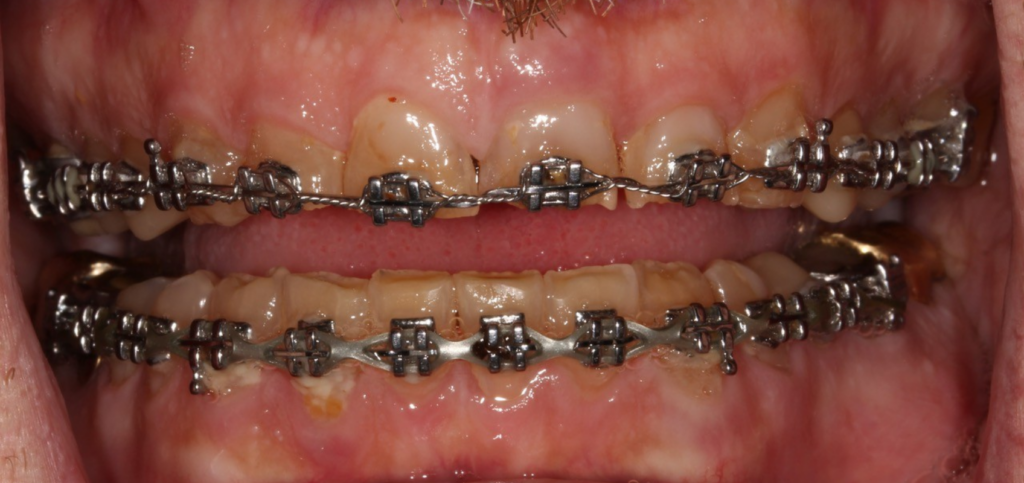 Restoring a Worn Dentition: Essential Treatment Considerations Close-up of anterior segmental wear before restoring a worn dentition, with uneven incisal edges on the upper central incisors