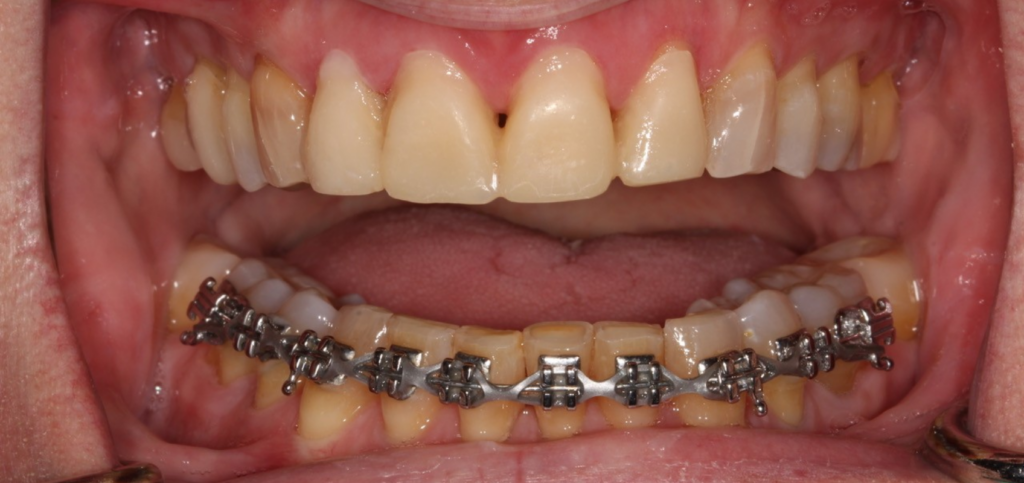 Restoring a Worn Dentition: Essential Treatment Considerations Composite trial therapy restorations on teeth #7-10, the first phase of restoring a worn dentition in this case