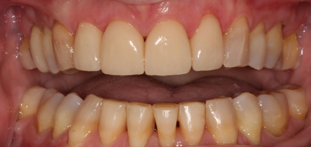 Restoring a Worn Dentition: Essential Treatment Considerations Porcelain restorations #7-10 delivered after trial therapy has been completed